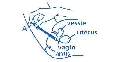 Image explicative pour insérer l’applicateur dans le vagin