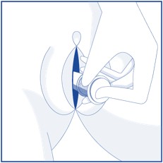 insertion 2
